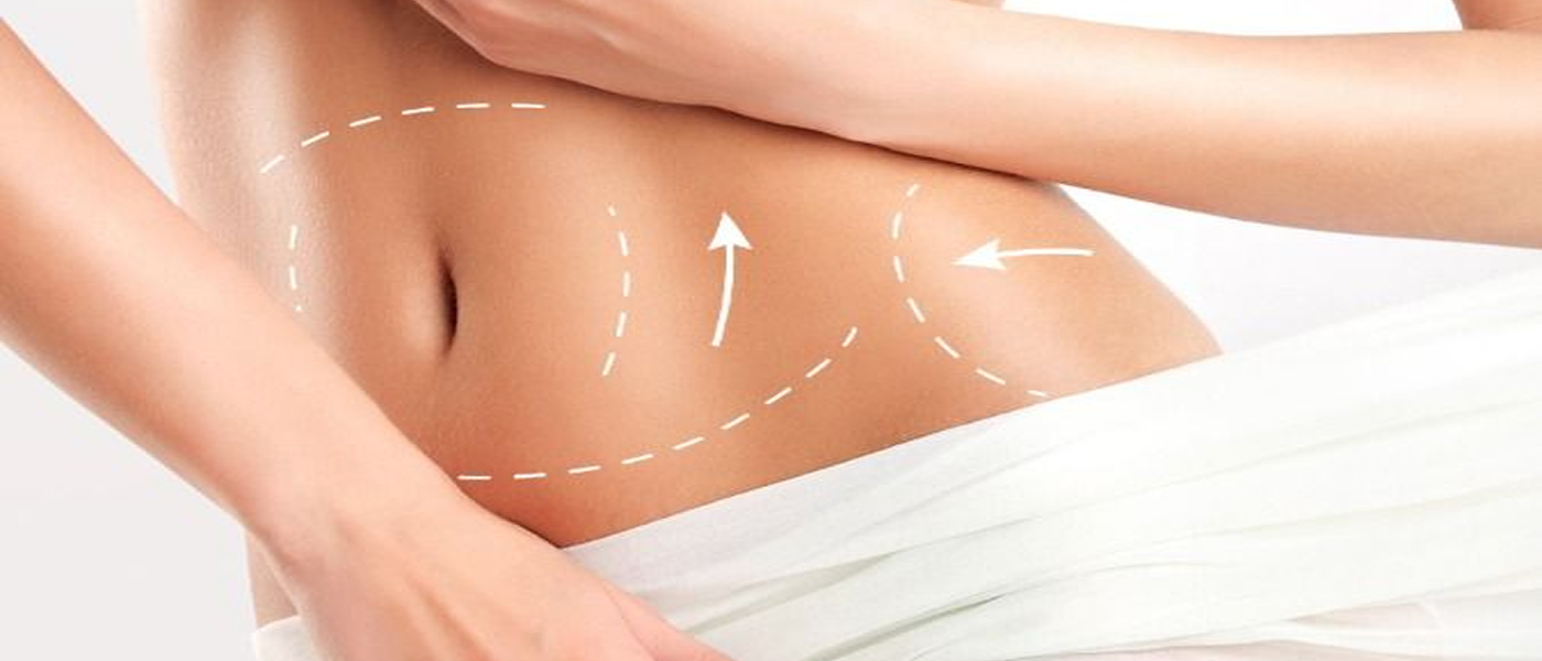 Hút mỡ tạo dáng